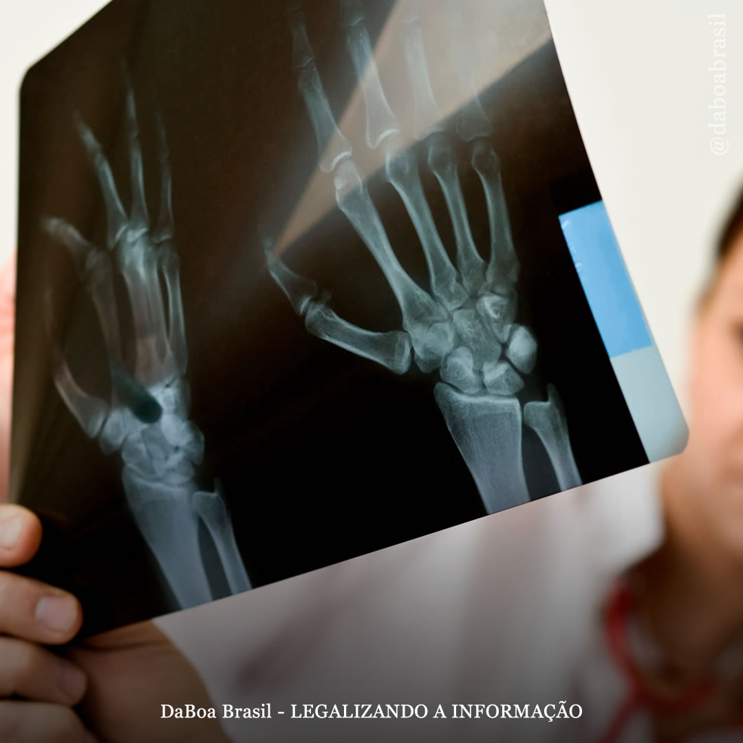 A maconha pode ajudar na saúde óssea?